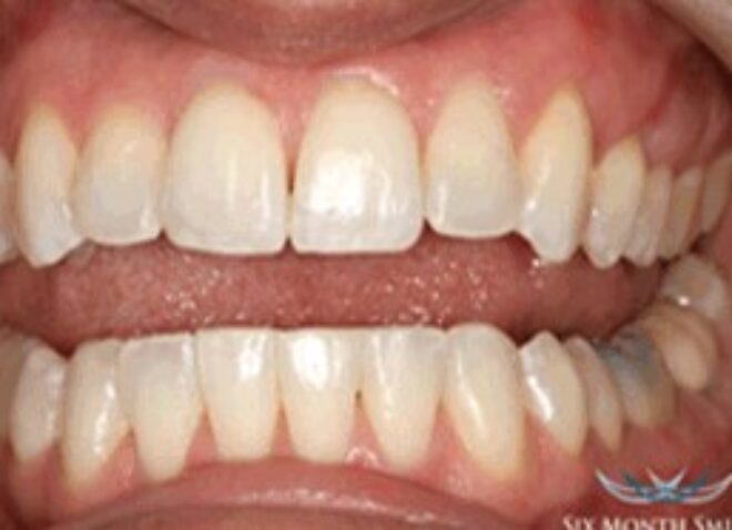 After - Dentistree Dental