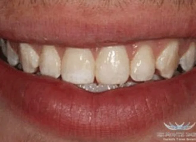 After - Dentistree Dental