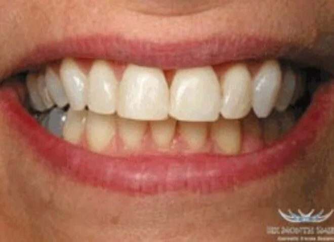 After - Dentistree Dental
