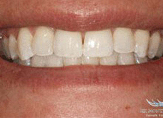 After - Dentistree dental