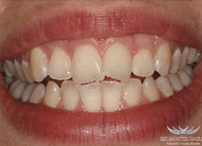 Before - Dentistree dental