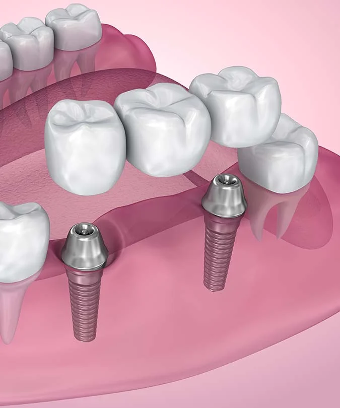 Treatment - Dentistree dental